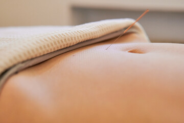 close up of acupuncture fertility treatment applied to the woman uterus area below the navel - obrazy, fototapety, plakaty