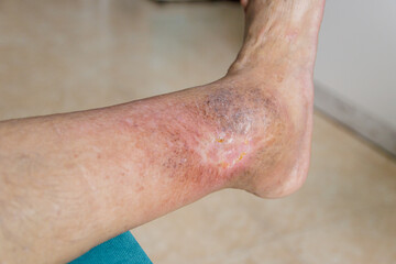 Leg senior person with ulcer due to diabetes - obrazy, fototapety, plakaty