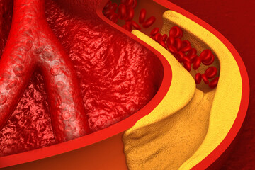 Clogged arteries on scientific background. 3d illustration.
