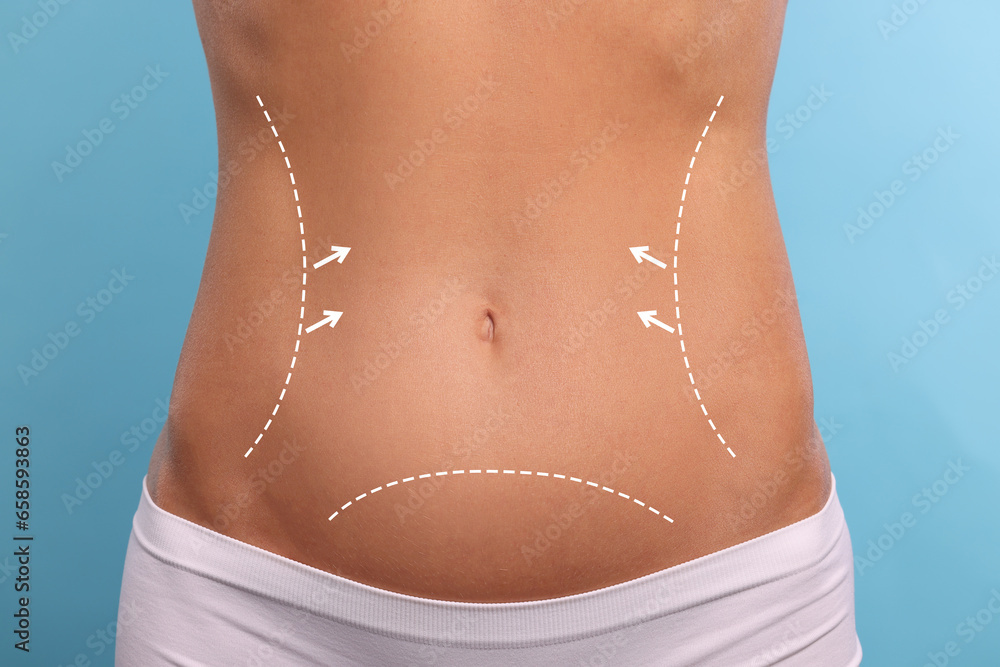 Wall mural Woman with markings for cosmetic surgery on her abdomen against light blue background, closeup