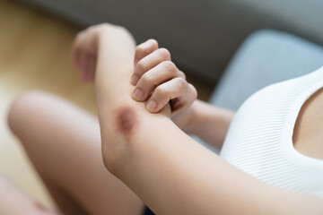Close-up purple bruised on the arm of human from accident.