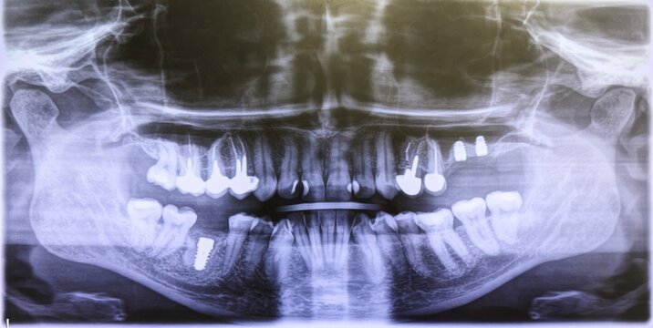 x-ray image of teeth. Teeth with dental crowns, dental sealants and a dental implant. Monochrome facial image. 
