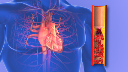Atherosclerosis or clogged arteries in the human heart