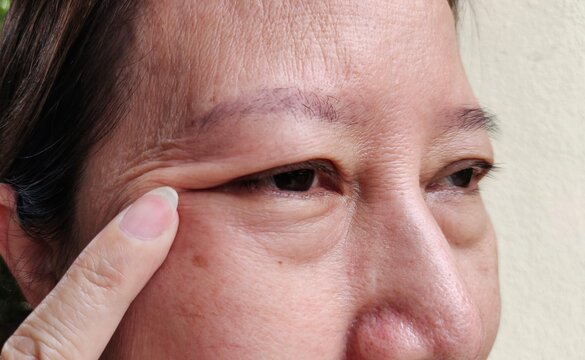 close up showing the fingers holding the flabbiness and wrinkle beside the eyelid, dark spots and blemish on the face of the woman, health care and beauty concept.