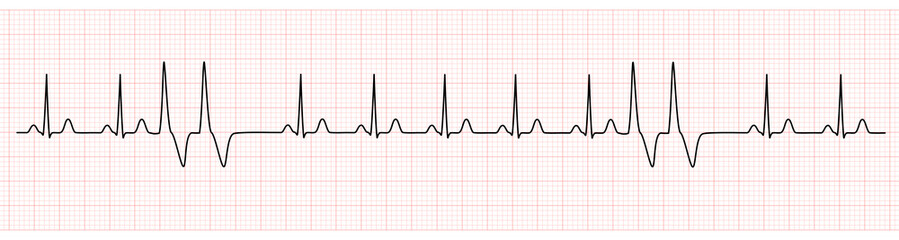 EKG Monitor Showing  Sinus Rhythm with Couplets PVC