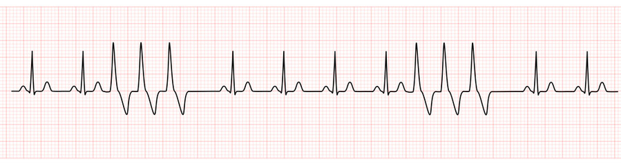 EKG Monitor Showing  Sinus Rhythm with Short Run VT - obrazy, fototapety, plakaty