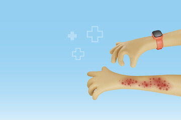 Hand suffering from raches, red blisters skin diseases. Chicken pox, monkey pox, orthopox virus outbreak. Medical and dermatitis skin care. Vector 3D cartoon character.  - obrazy, fototapety, plakaty