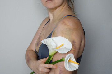 Thigh Injury from a collision, impact or fall, bruised woman skin. Bruise on people