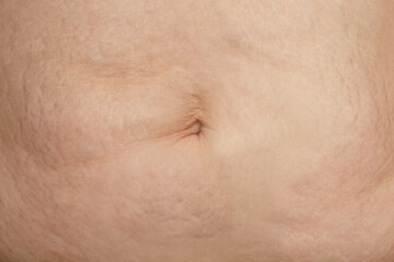 Fototapeta premium Stretch mark on female skin, belly closeup
