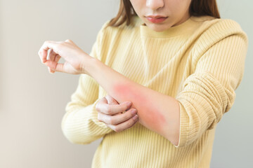 Naklejka premium Dermatology asian young woman, girl allergy, allergic reaction from atopic, insect bites on her arm, hand in scratching itchy, itch red spot or rash of skin. Healthcare, treatment of beauty.