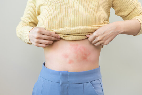 Dermatology injury asian young woman allergy, allergic reaction from atopic, insect bites or shingles on stomach, girl scratching itchy, itch red spot or rash of skin. Healthcare, treatment of beauty.