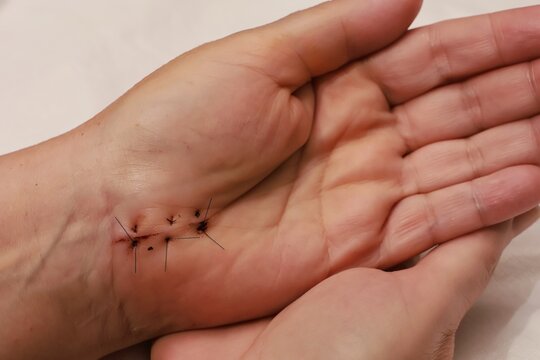 Stitches on the wrist after carpal tunnel surgery.