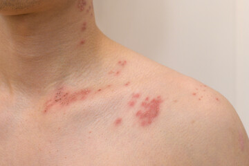 close up of man with shingles disease on skin