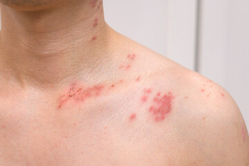 Fototapeta premium close up of man with shingles disease on skin