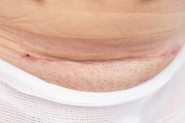 A woman shows off a fresh scar from a caesarean section.