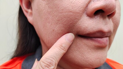 Obraz premium portrait showing the fingers holding the wrinkle and smile lines beside the mouth, dark spots and blemish on the face of the woman, health care and beauty concept.