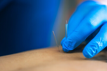 Close up of a needle and hands of physiotherapist doing a dry needling.