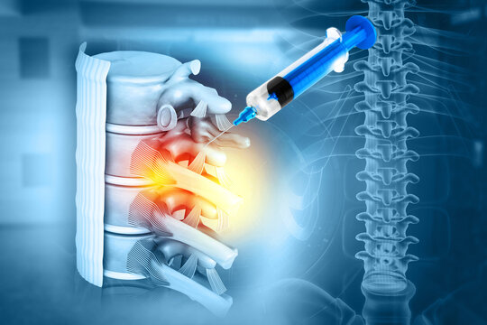 3d illustration of a lumbar spine injection