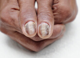 Close up view of the spoiled hand nails of an elderly diabetic patient