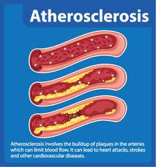Science Education: Human Anatomy and Atherosclerosis Infographic
