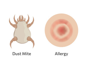 Skin allergy to dust mites vector illustration design.