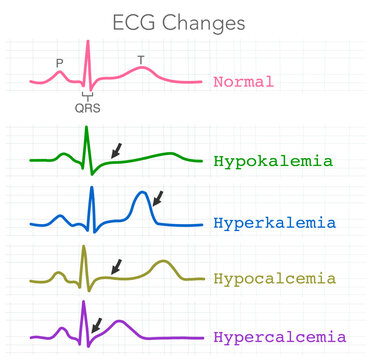 ECG changes. Hypokalemia, Hyperkalemia, Hypercalcemia, Hypocalcemia. Cardiac rhythm. Hearth beat atrial fibrillation. T colored wave p. QRS complex. Illustration vector