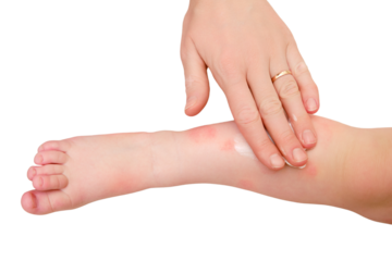 Toddler baby skin care, allergies and dermatitis, isolated on white background. A mother woman smears red spots of allergy and atopic dermatitis on the child skin with cream