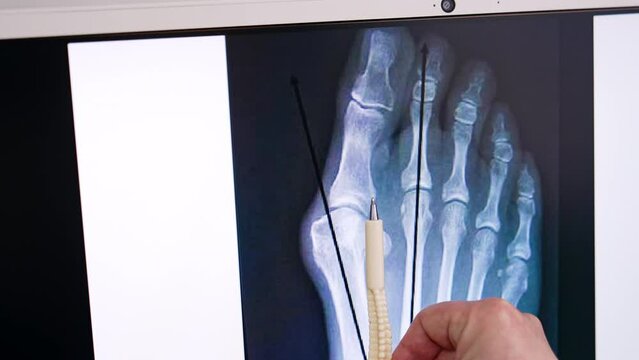 X-ray scan of a foot with valgus deformity. Doctor's hand puts the pen showing the correct toe position. Close up.