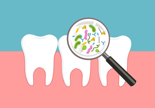 The most common bacteria associated with dental cavities are the mutans streptococci, most prominently Streptococcus mutans and Streptococcus sobrinus.