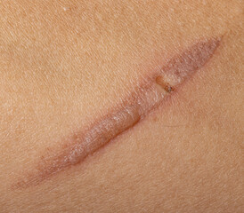 Fototapeta premium burn on hand as background.