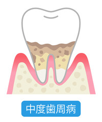 中度歯周病