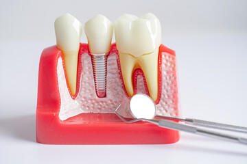 Dental implant, artificial tooth roots into jaw, root canal of dental treatment, gum disease, teeth...