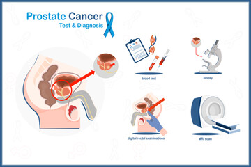Medical vector illustration in flat style of prostate cancer in prostate cancer analysis and diagnosis concept.blood test,biopsy,MRI scan,digital rectal examination.isolated on white background.
