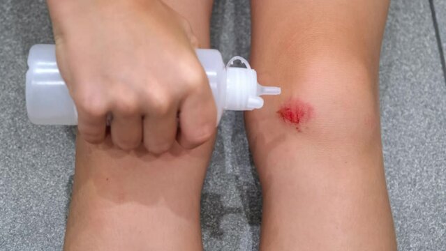 Treatment of an abrasion on the knee with an antiseptic. A child treats a wounded knee with hydrogen peroxide. Abrasion on the lap of boy close-up after the fall. A scratch with blood. Body trauma.