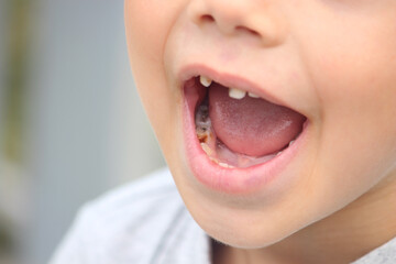 Fototapeta premium a boy without a tooth. Selective focus.