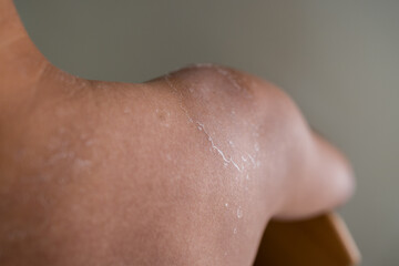 Fototapeta premium Man get sun burn with sloughs off on his shoulder