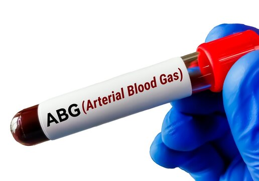 Blood sample tube for ABGs (arterial blood gases) test