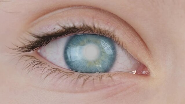 Cataract of human eye. Defect of transparency of the cornea