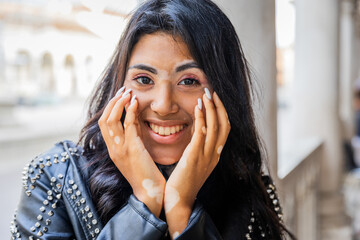 Portrait of a smiling teenage girl with vitiligo touching her face with her hands