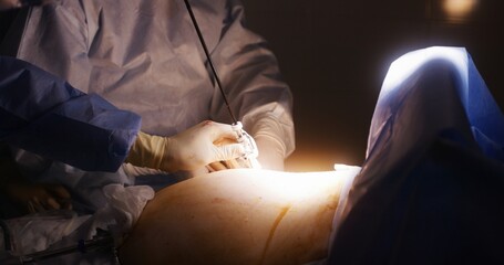 Close up of professional surgeon in surgical suit with colleague inserting injection of anesthesia in stomach of patient. Medics prepare to surgical operation. Medical staff at work in medical center.