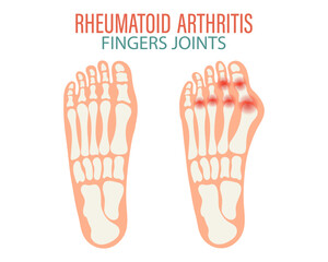 Rheumatoid arthritis icons. Knee joint, shoulder joint, wrist joint, hip joint, foot joint. Types of arthritis. Medical concept. Vector