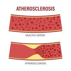 Healthy and atherosclerotic vessels with blood cells. Cholesterol in blood vessels. Atherosclerotic plaque. Medicine, science, healthcare. Infographics banner