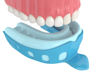 3d render of upper jaw with dental impression tray - obrazy, fototapety, plakaty