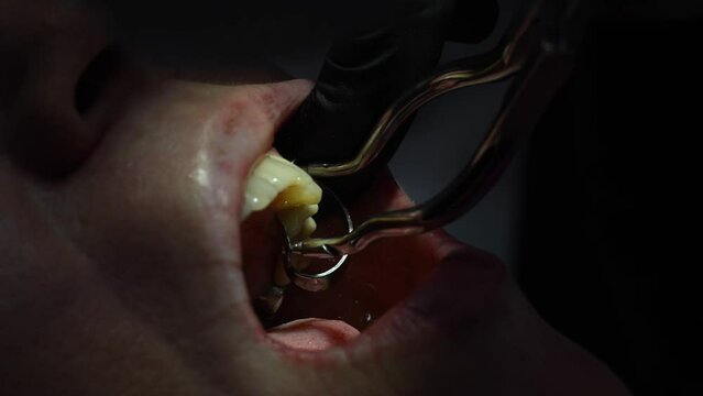 Dental Extreme Close up Macro Video. Dentist treat patient teeth. Dental internist works with an assistant use cofferdam. Concept of professional dental hygiene. 4k 120 fps slow motion raw footage