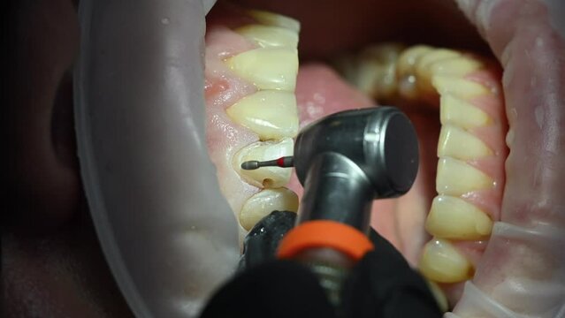Dental Extreme Close up Macro Video. Dentist treat patient teeth. Dental internist works with an assistant use cofferdam. Concept of professional dental hygiene. 4k 120 fps slow motion raw footage