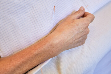 Needles on acupuncture uterus points of a woman hand during a traditional chinese medicine fertility treatment