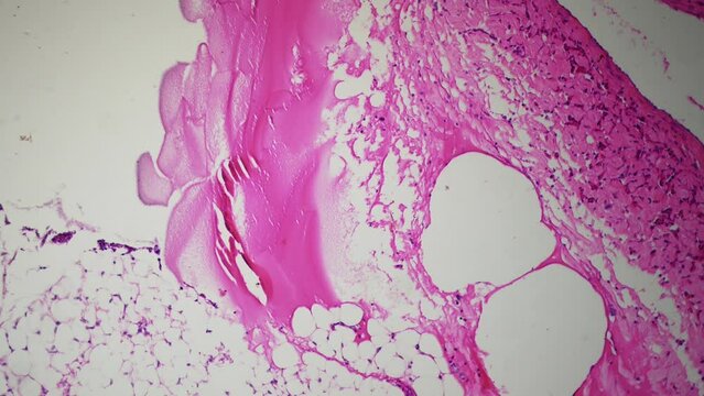Real specimen of human vein, multiple magnification under microscope. Signs of atherosclerosis, decreased vascular elasticity, circulatory disorders. Smooth movement and focusing. Cross section slide