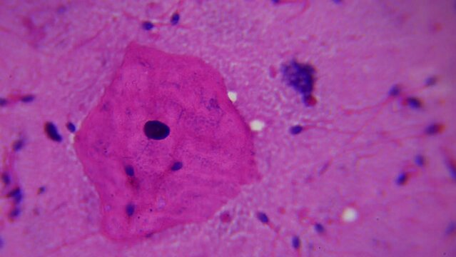 Human sperm specimen under a microscope in a scientific laboratory. Through an optical microscope. 1000x times increase. Fertility. Sexually transmitted diseases