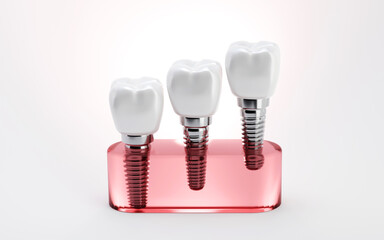 3D rendering of tooth and dental implant for stomatology set on product display, Implants surgery concept