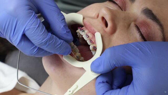 Orthodontist in medical gloves installs an arc in ligature braces on client's teeth. Close-up top view of woman face. Concept of dentistry treatment for correction of malocclusion